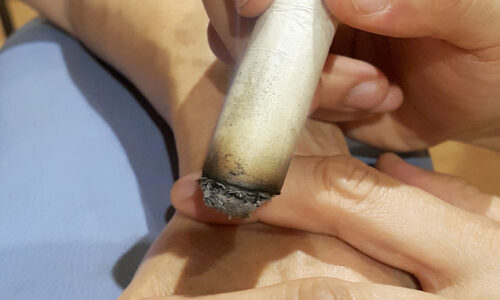 Moxibustion inicial